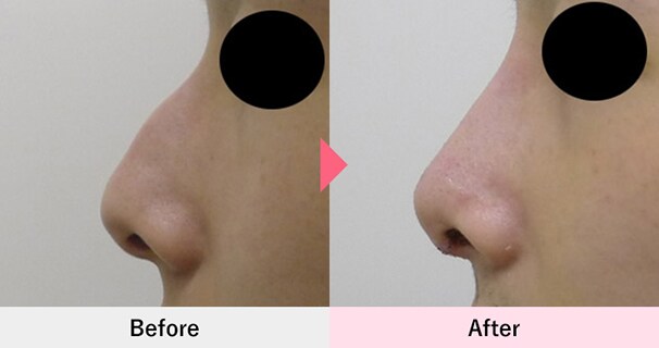 ワシ鼻修正術・ハンプ切除の症例写真3