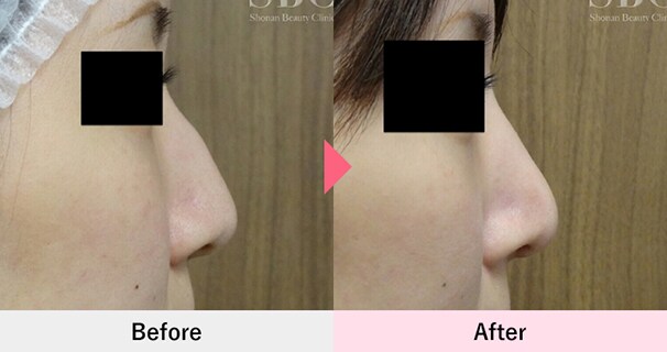 ワシ鼻修正術・ハンプ切除の症例写真2