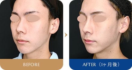 本間 重行医師 SBCプレミアムソフトプロテーゼ 、鼻尖形成3D法、鼻尖部(耳介)軟骨移植、鼻中隔延長(鼻中隔軟骨) 症例写真2