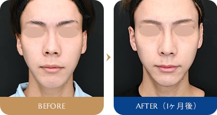 本間 重行医師 SBCプレミアムソフトプロテーゼ 、鼻尖形成3D法、鼻尖部(耳介)軟骨移植、鼻中隔延長(鼻中隔軟骨) 症例写真5