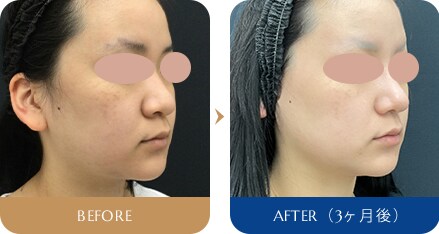 岩間 晋 医師 鼻尖形成術3D法／鼻尖部軟骨移植／外側内側両方+締め付け縫合 症例写真4