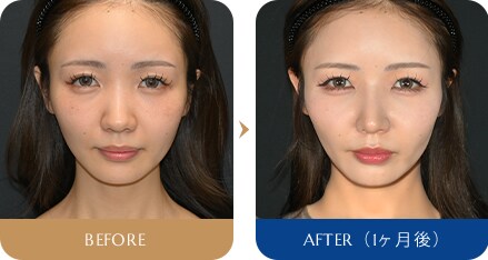 中野 達生医師 SBCナチュラルフィットプロテーゼ,鼻尖形成術3D法,鼻尖部軟骨移植,鼻柱下降術,鼻中隔延長術(鼻中隔軟骨),猫手術 症例写真4