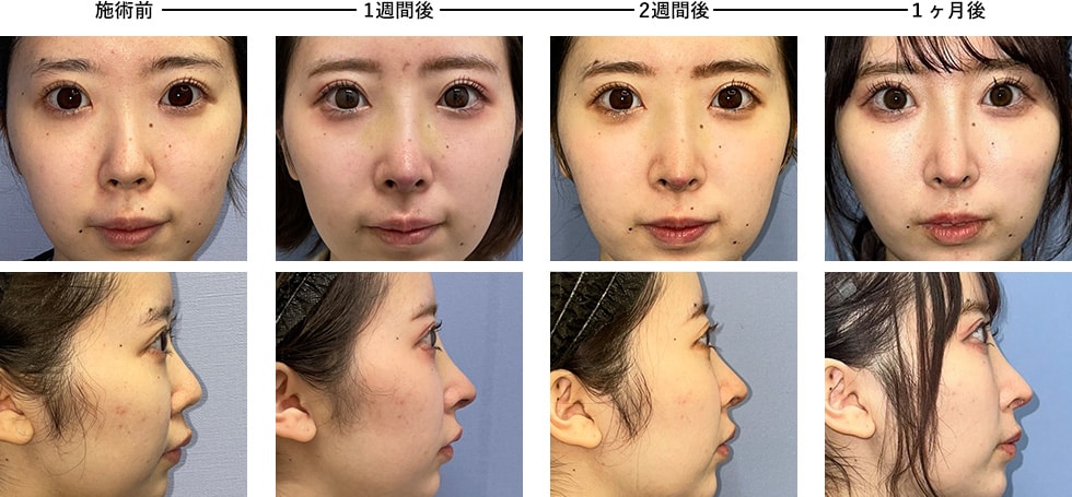 鼻整形・鼻形成のダウンタイム