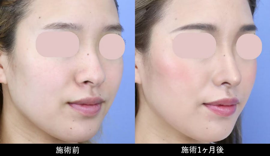 鼻フル忘れ鼻セット症例写真