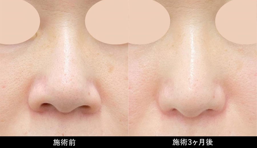 鼻フル忘れ鼻セット症例写真