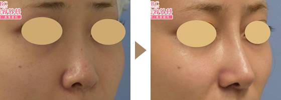 鼻尖形成+軟骨移植+SBCプレミアムプロテーゼ 複合手術 症例写真 ビフォーアフター