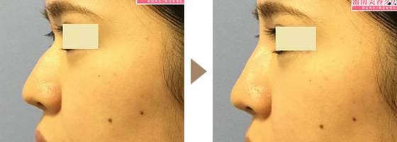 Fineha Ultra(ピネハウルトラ)