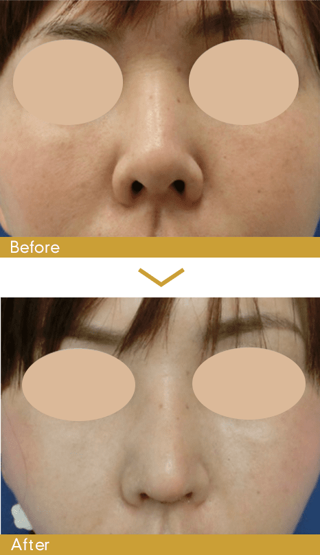 鼻中隔延長術の症例写真1