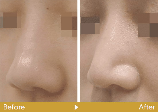 鼻中隔延長術の症例写真2