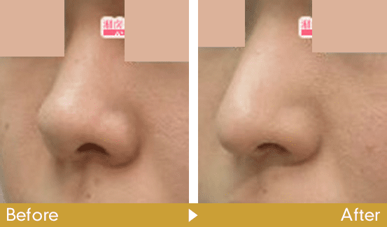 鼻中隔延長術の症例写真3