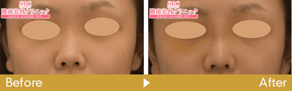 鼻中隔延長術の症例写真5