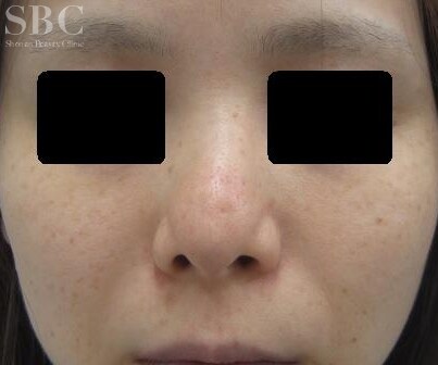 鼻骨骨切り術 鼻整形なら湘南美容クリニック 公式