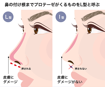 SBCプレミアムソフトプロテーゼ(鼻プロテーゼ)｜鼻整形なら湘南美容 