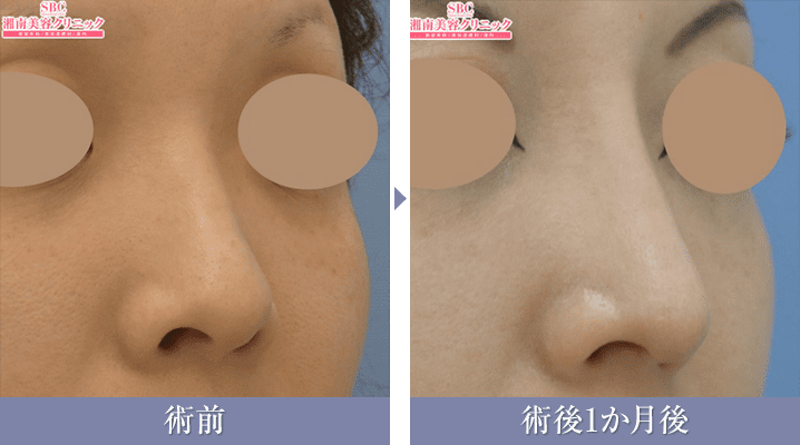 鼻尖形成術3D法+鼻中隔延長術（鼻中隔軟骨）+SBCプレミアムソフトプロテーゼの症例写真{症例193960}