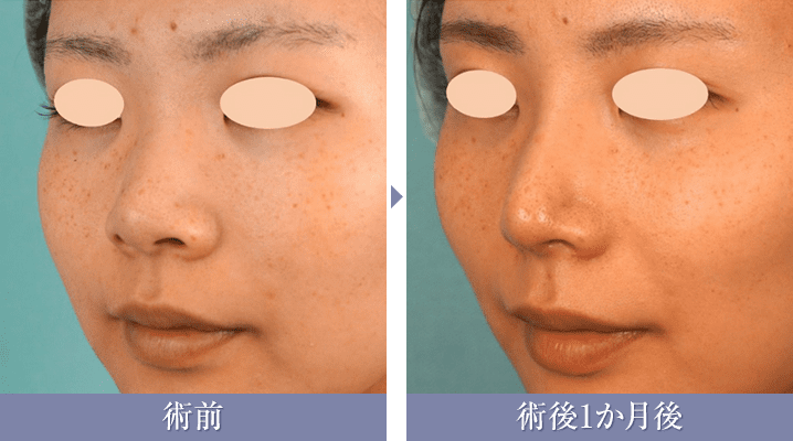 鼻尖形成術3D法+小鼻縮小（内側法）+SBCプレミアムソフトプロテーゼの症例写真{症例199152}