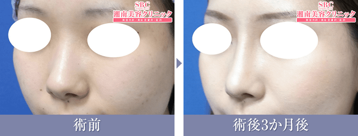 SBCプレミアムソフトプロテーゼ+鼻尖形成術3D法+鼻中隔延長術（鼻中隔軟骨）の症例写真{症例190757}