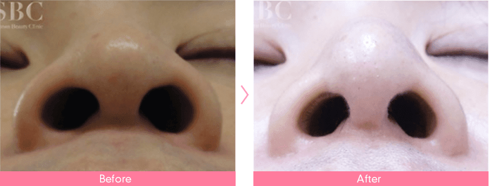 鼻尖形成術（だんご鼻解消術）のピックアップ症例