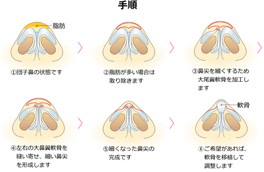 クローズド法