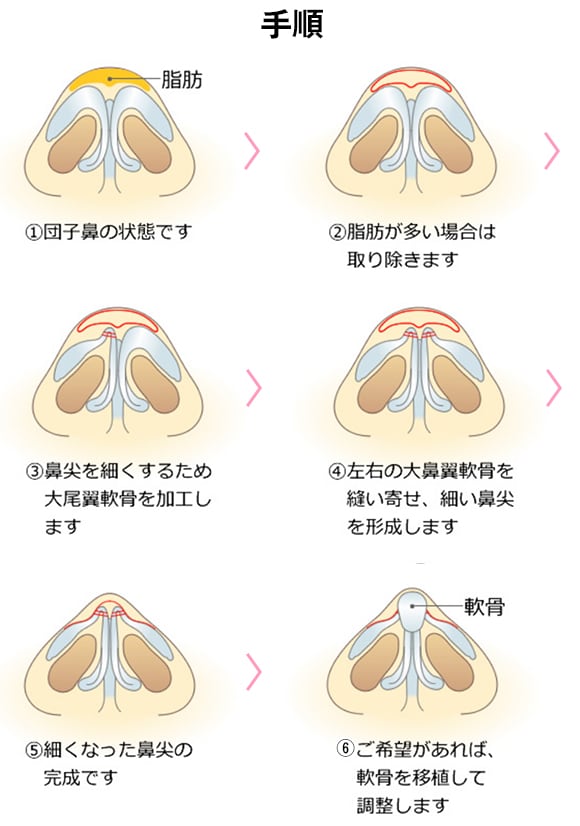 クローズド法