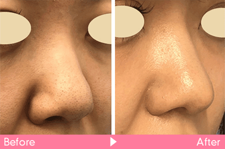 鼻尖形成と軟骨移植と小鼻縮小施術を合わせた症例写真