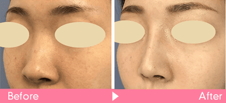 SBCプレミアムソフトプロテーゼ挿入と鼻尖形成術と鼻尖部軟骨移植と小鼻縮小を合わせた症例写真