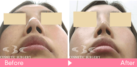 鼻尖形成術＋小鼻縮小（鼻腔内切開）の症例写真