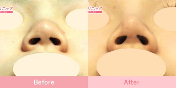 鼻尖形成とSBCソフトプロテーゼの施術後1ヵ月の症例写真