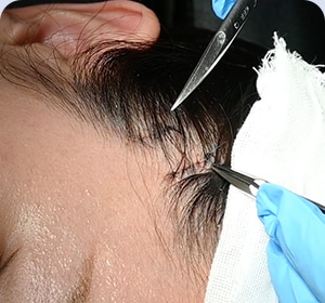 1週間後(抜糸前) 画像