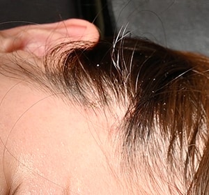 1週間後(抜糸後) 画像