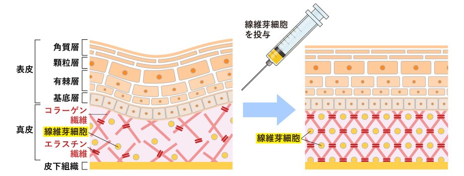 培養にて増えた線維芽細胞の投与 イメージ画像