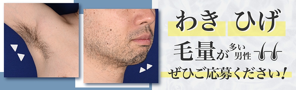 医療脱毛男性