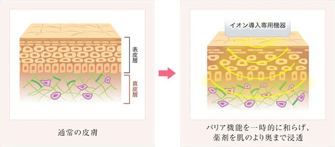 イオン導入の仕組み