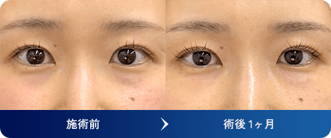 デューコラーゲン(Deusaderm) 症例写真7