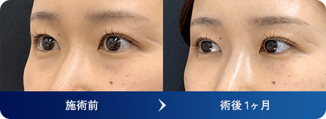 デューコラーゲン(Deusaderm) 症例写真8