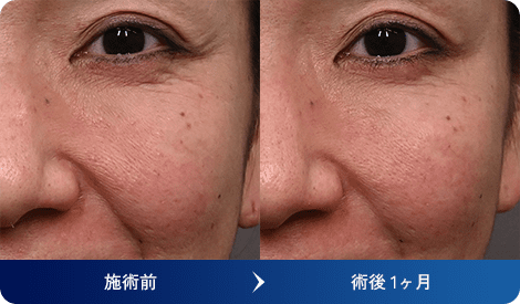 デューコラーゲンブースター(Deusaderm) 症例写真5