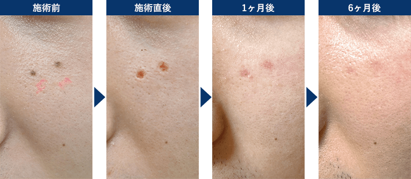 ほくろ除去(CO2レーザー) 術前 6カ月後