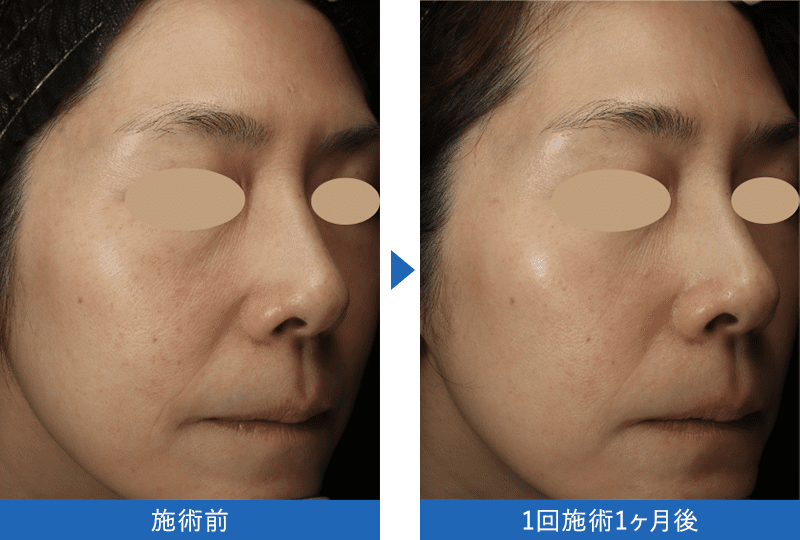 女優水光注射 症例写真 1回施術1ヶ月後