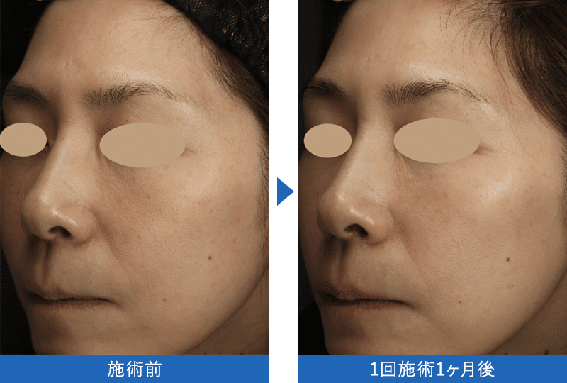 女優水光注射 症例写真 1回施術1ヶ月後