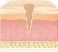 アイスピック型