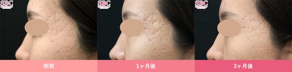 ニキビ跡の凹み治療のピックアップ症例