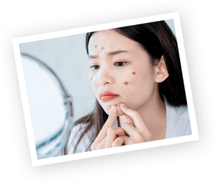 ニキビができる原因 イメージ