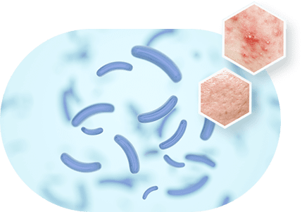 ニキビができるしくみと悪化する流れ イメージ2