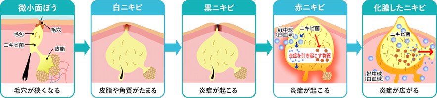 ニキビができるしくみと悪化する流れ イメージ3