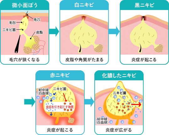 ニキビができるしくみと悪化する流れ イメージ3
