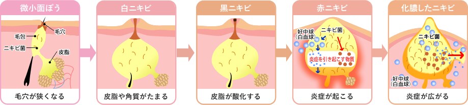 ニキビができる原因