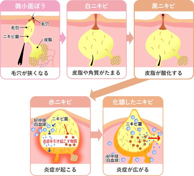 ニキビができる原因