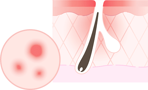 赤みのあるニキビ跡の原因