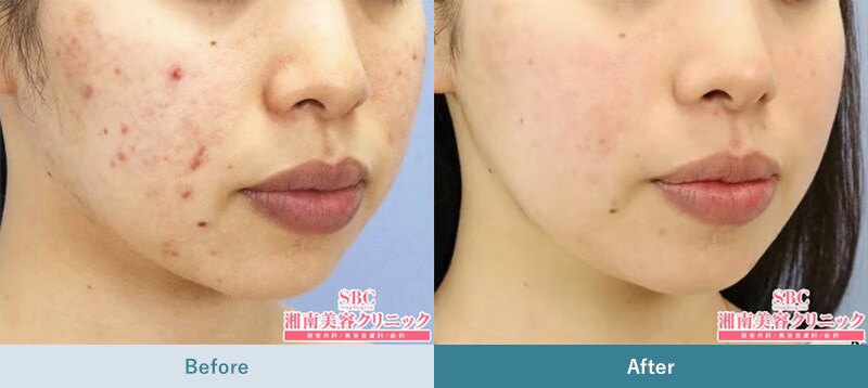 湘南美容クリニックのニキビ跡赤み治療
