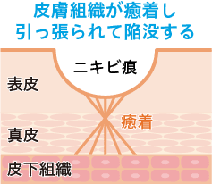 皮膚組織が癒着