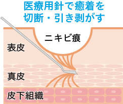 医療用針で切断